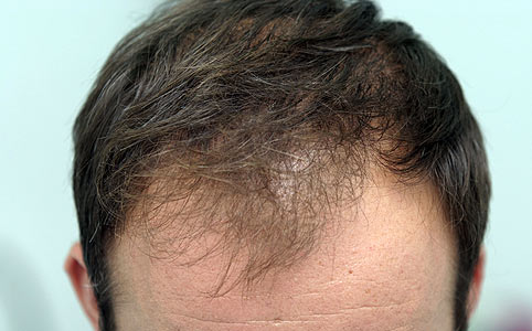 Hajhullás, kopaszodás, korpa - Vajon mi áll a hajbetegségek hátterében?