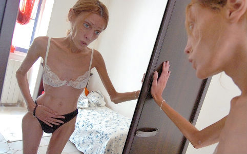 Meghalt a sokkoló anorexiás modell