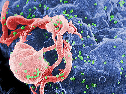 Eltüntette a HIV vírust a csontvelő-átültetés