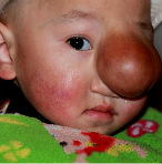 Életveszélyes daganat a kisbaba arcán